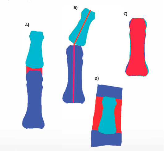 EULAR2024_Highlights_Reuma&IA