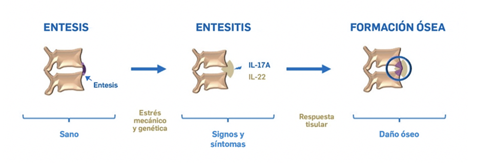 EspondiloartritisAxial_Entesis EspondiloartritisAxial_Entesis