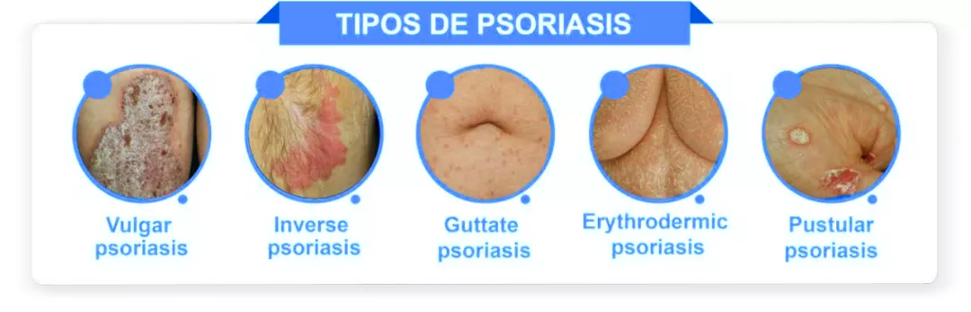 Epidemiologia&Psoriasis_Tipos
