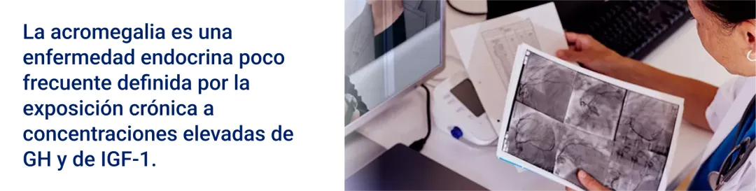 Acromegalia