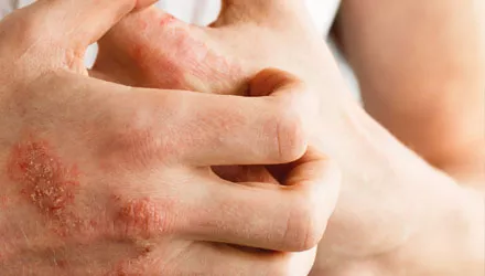 thumb-psoriasis-arthritis-symptome