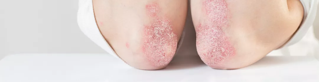 Psoriasis an den Unterarmen