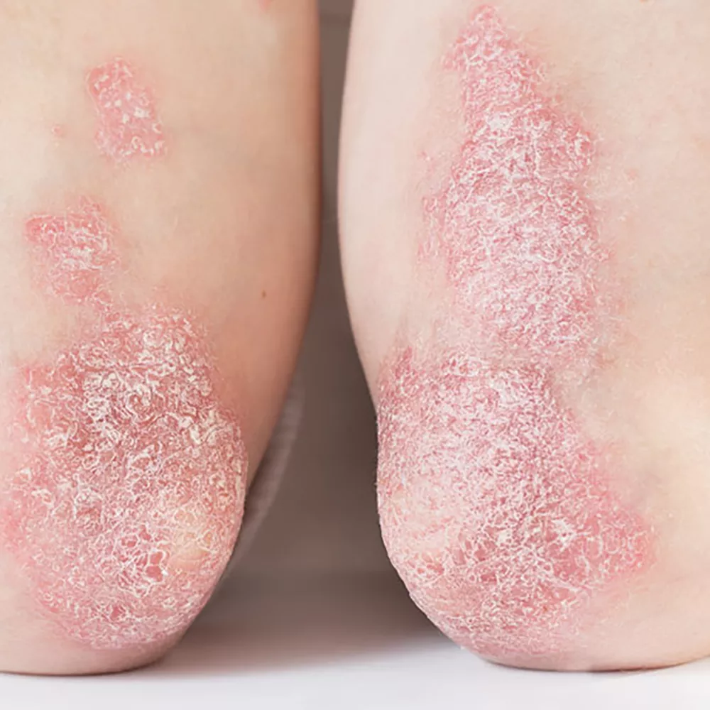 Psoriasis Arthritis an den Unterarmen