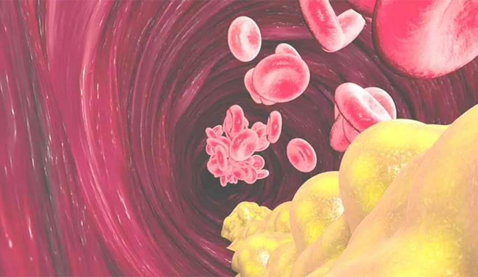 Teaser Hypercholesterinämie