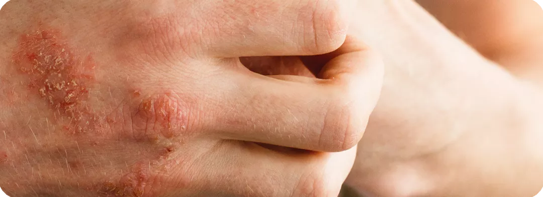 Psoriasis an den Händen