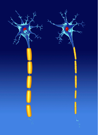 Illustration of damaged neurons