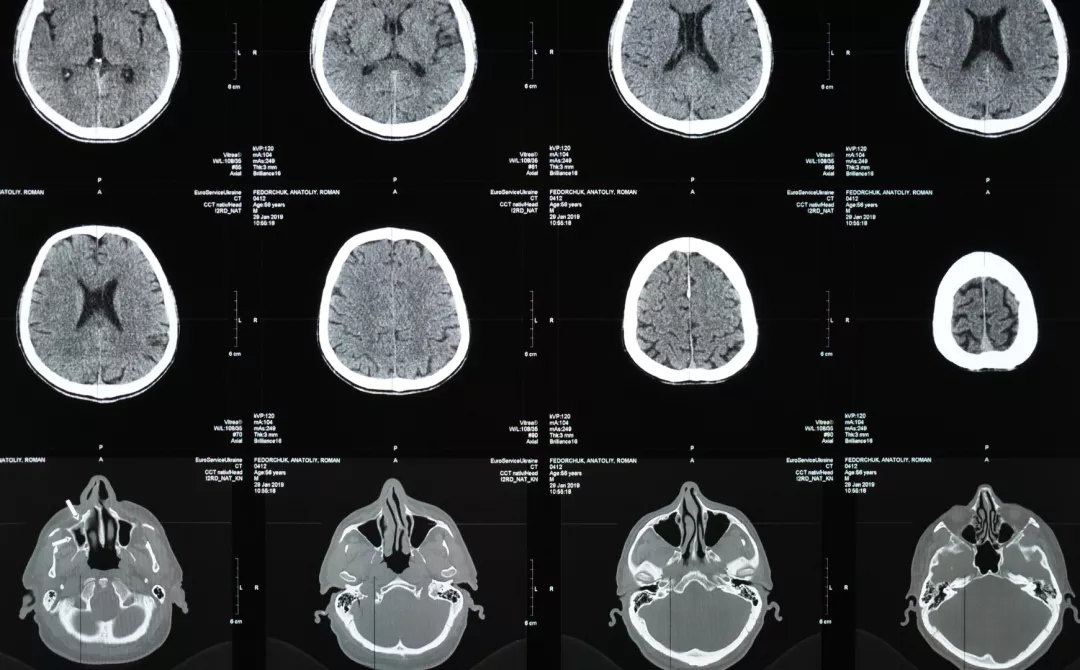Illustration of brain MRI scans