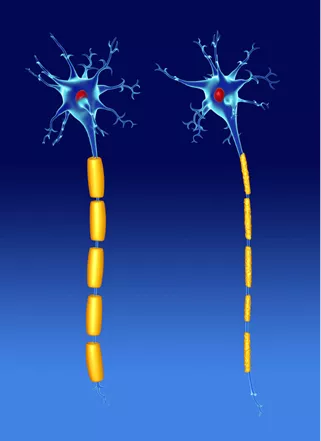 Illustration of damaged neurons