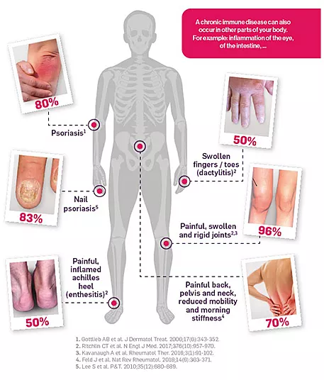 Infographic of body parts affected by PSA