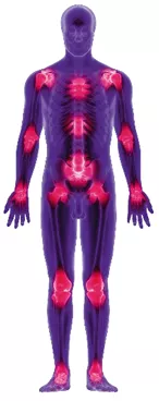 Illustration of body parts affected by PsA