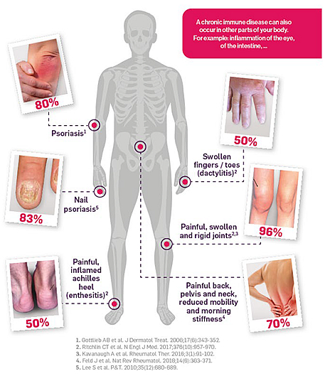 Infographic of body parts affected by PSA Infographic of body parts affected by PSA