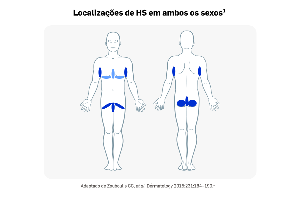 cosentyx-estadiamento-e-tratamento-hs-fig1