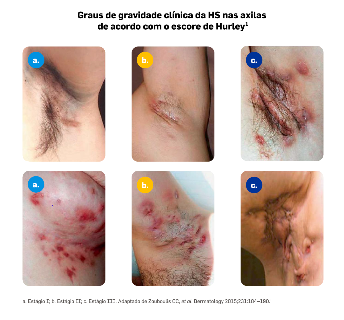 cosentyx-estadiamento-e-tratamento-hs-fig2
