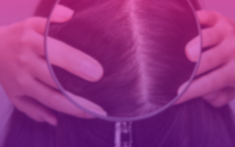 img-psoriase-couro-cabeludo-topo2