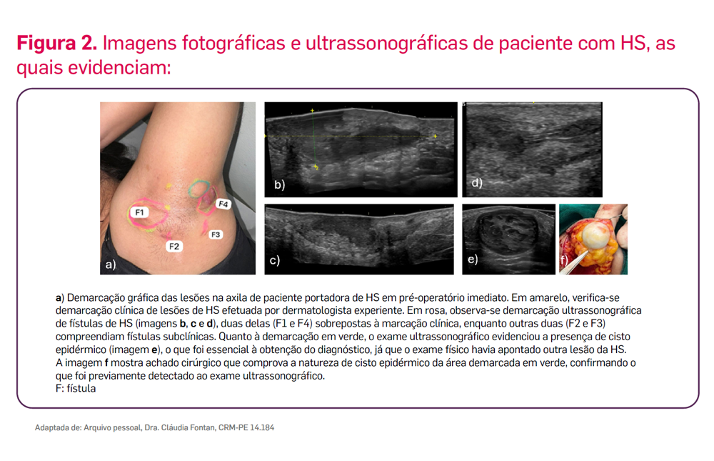 img-consentyx-hs-ultrassonografia-2