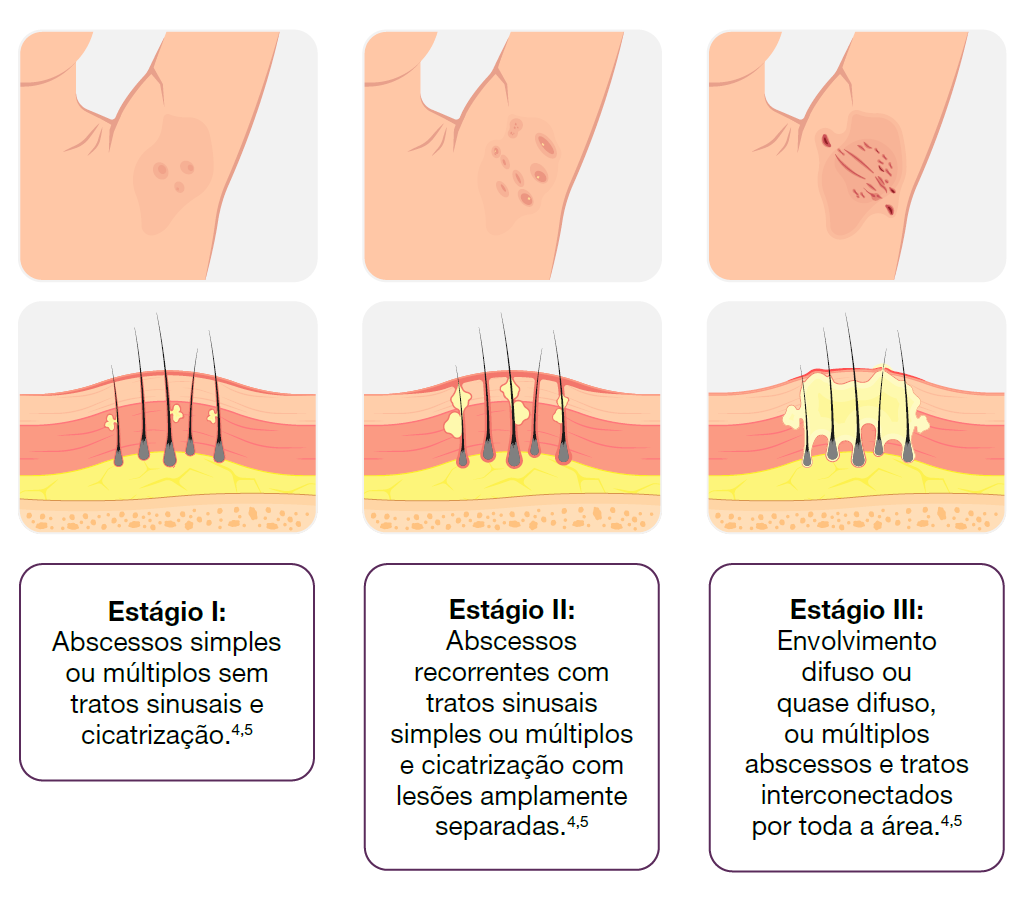img-cosentyx-avaliacao-gravidade-hs1
