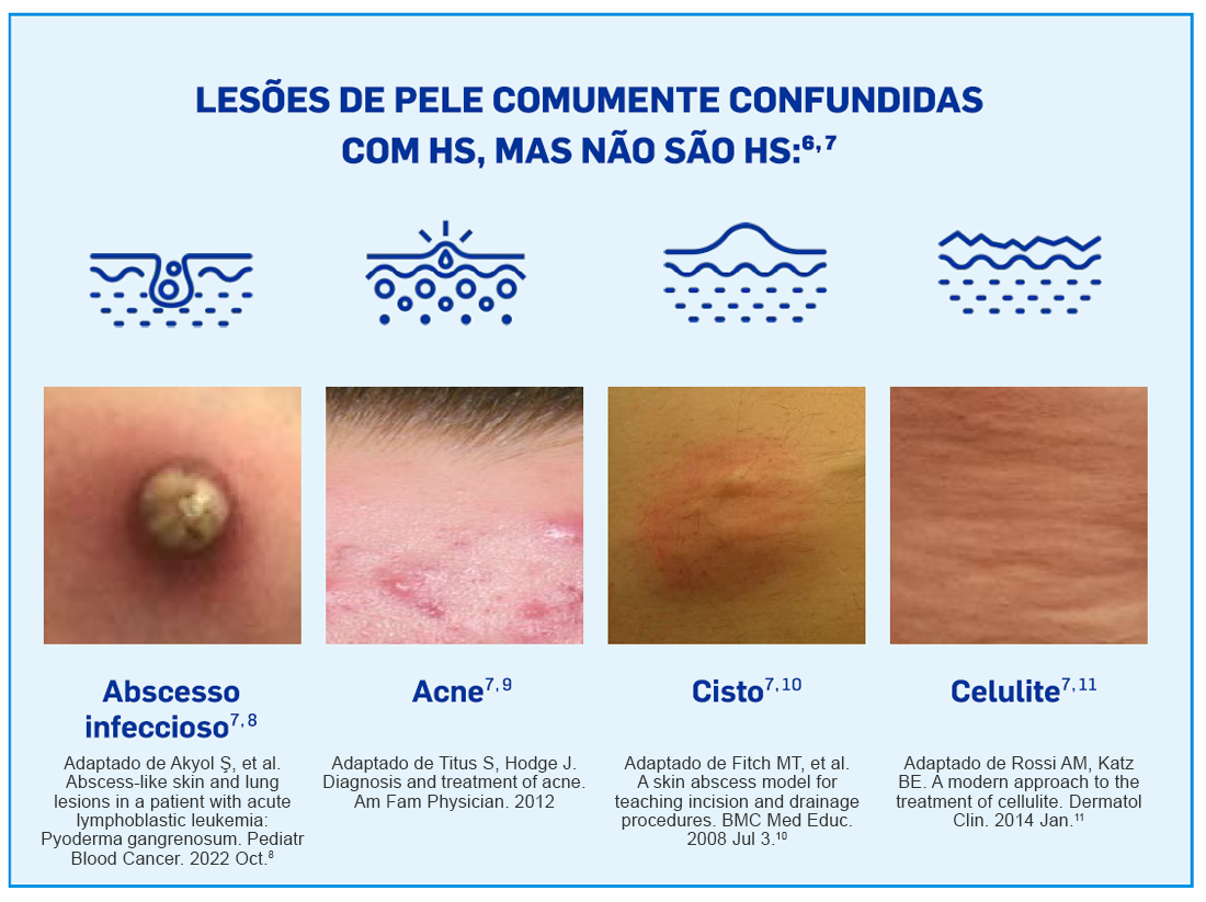 img-cosentyx-hs-burden-grafico1 img-cosentyx-hs-burden-grafico1