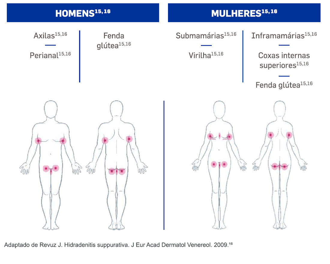 img-cosentyx-hs-burden-grafico3 img-cosentyx-hs-burden-grafico3