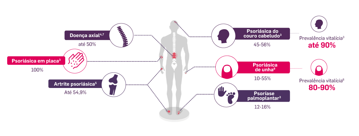 img-evitar-progressao-psoriase-para-atrite-psoriasica02 img-evitar-progressao-psoriase-para-atrite-psoriasica02