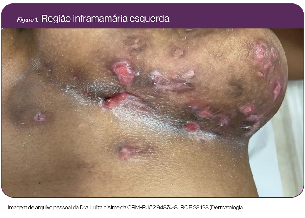 img-cosentyx-hs-caso-mamarias-mamas1