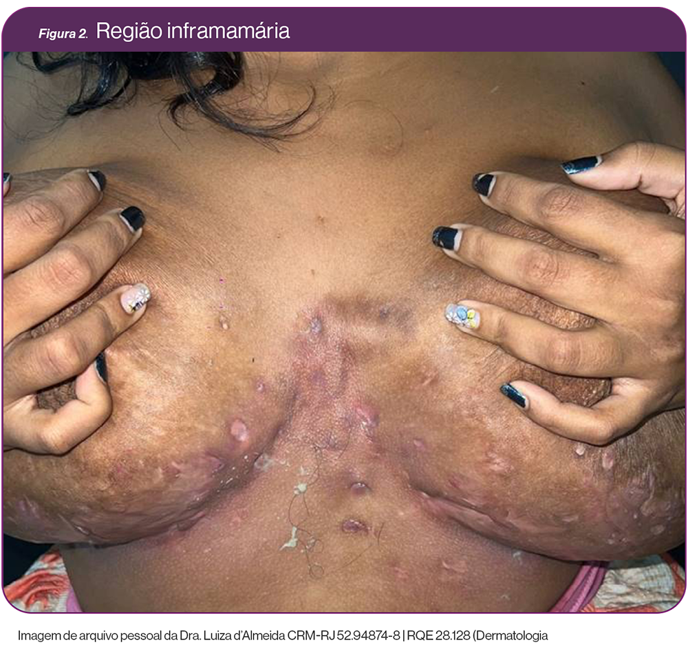 img-cosentyx-hs-caso-mamarias-mamas2
