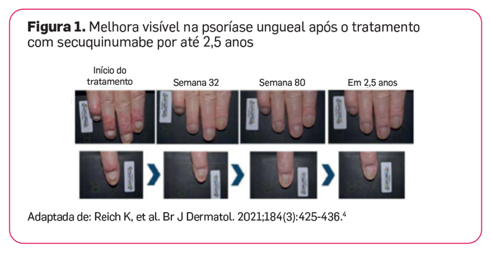 img-cosentyx-pso-areas-especiais-05