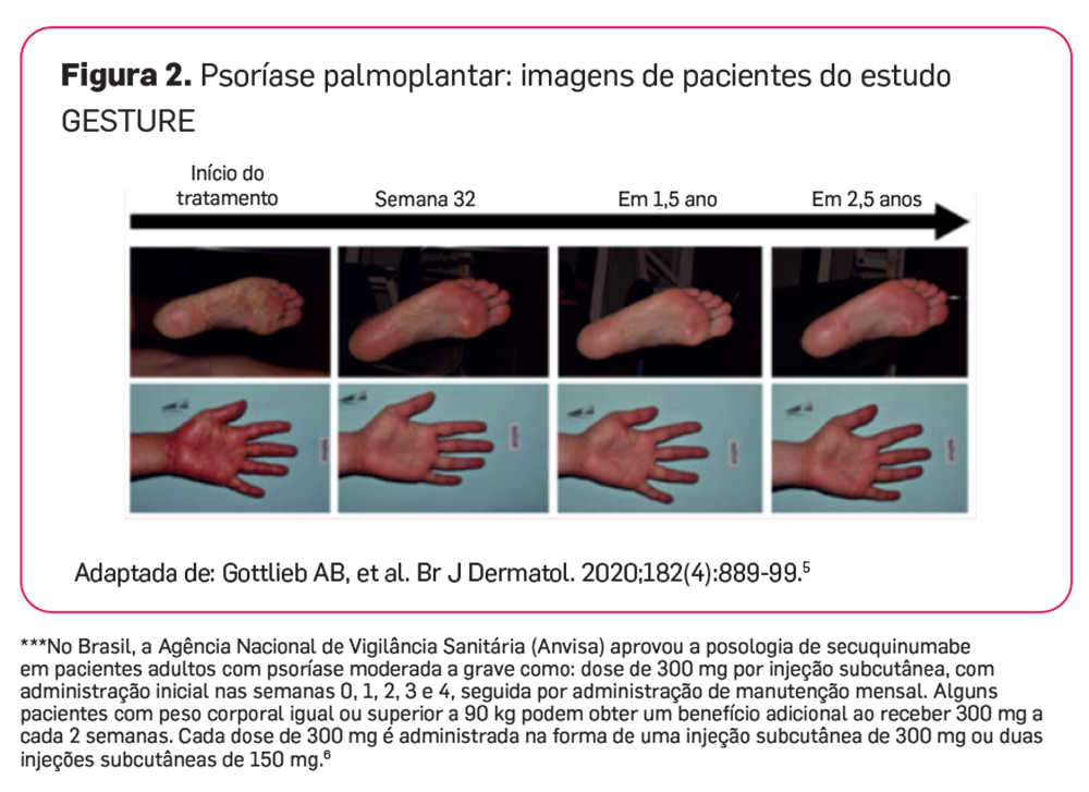 img-cosentyx-pso-areas-especiais-07
