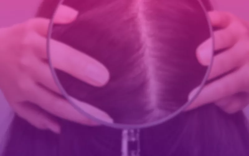 img-psoriase-couro-cabeludo-topo2