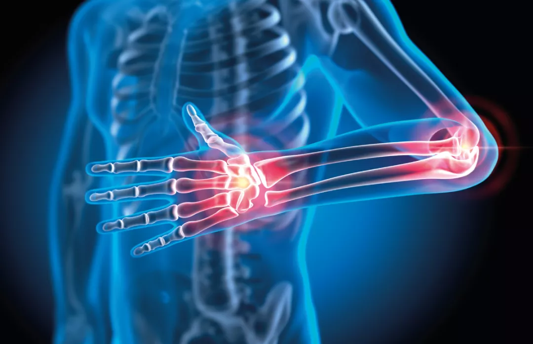 img-grappa-artrite-psoriasica-topo