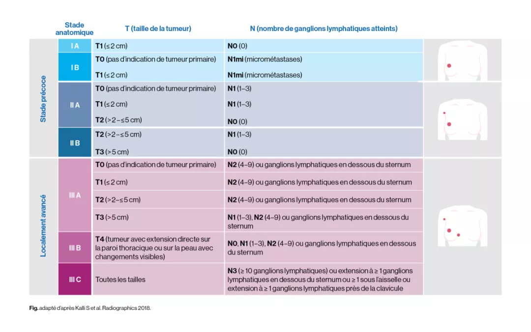 Classification TMN: cancer du sein à un stade précoce
