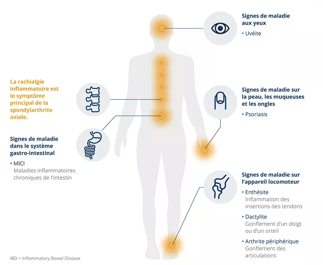 spondylarthrite axiale