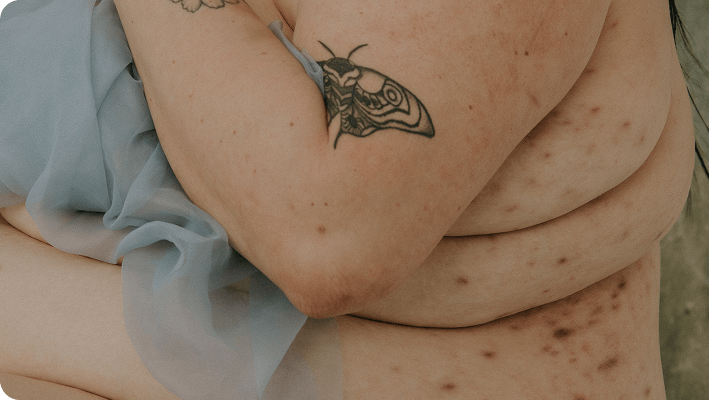 Lesiones visibles de hidradenitis supurativa: diagnóstico y evaluación clínica Paciente con hidradenitis supurativa mostrando lesiones inflamatorias en la piel.