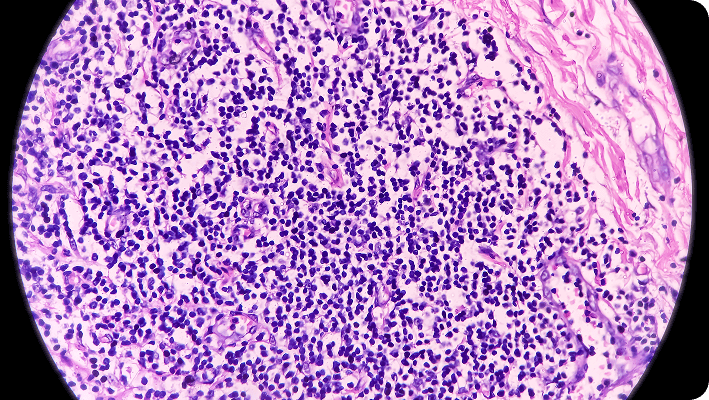 Tejido inflamado en hidradenitis supurativa: análisis bajo microscopio Imagen microscópica de tejido inflamado en hidradenitis supurativa, mostrando acumulación celular característica