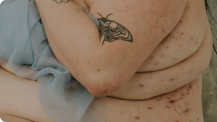 Hidradenitis Supurativa Hidradenitis Supurativa