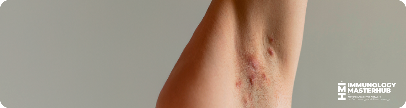 Axila afectada por hidradenitis supurativa