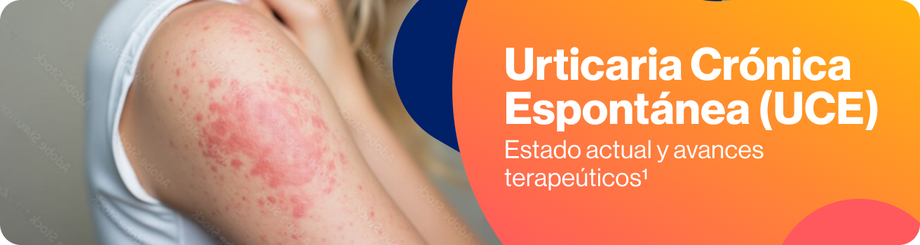 Urticaria Crónica Espontánea (UCE)