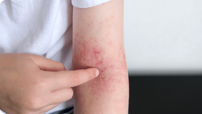 Piel afectada por hidradenitis supurativa Lesiones en la piel