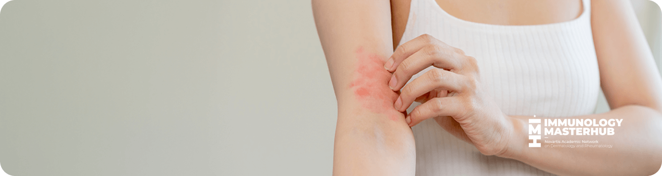 información sobre hidradenitis supurativa Novartis banner para la página de hidradenitis supurativa mostrando una persona con lesiones en la piel de su brazo