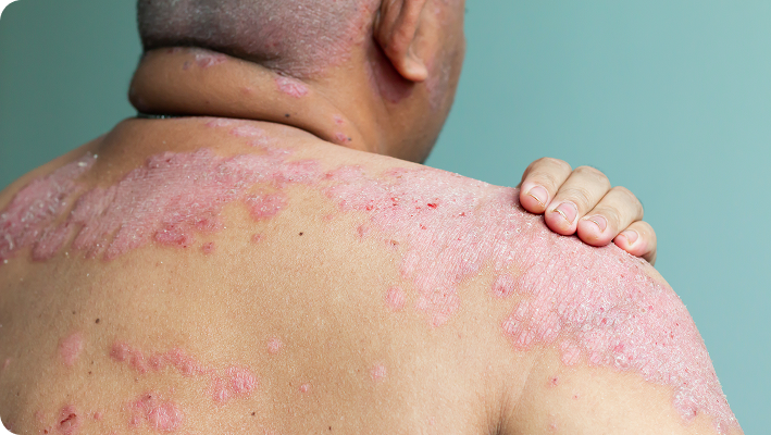 PsoriasisLessionBack PsoriasisLessionBack