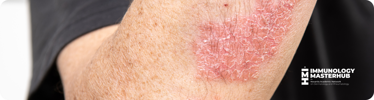 Banner2Psoriasis2025 Banner2Psoriasis2025
