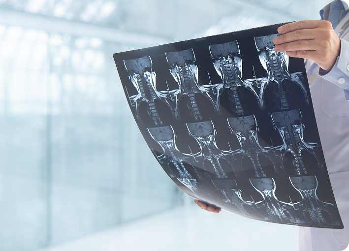 EspondiloartritisRadNeck EspondiloartritisRadNeck