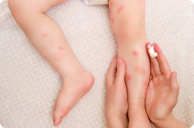 PsoriasisLessionLegsBaby PsoriasisLessionLegsBaby