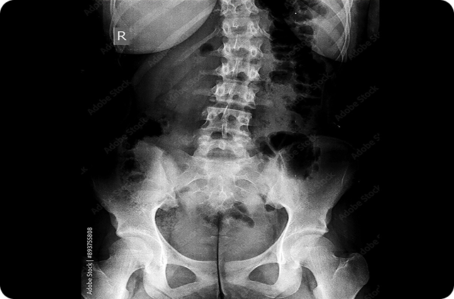 EspondiloartritisLessionHip EspondiloartritisLessionHip