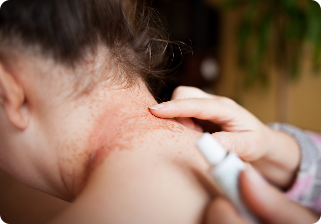 cuello_mujer_hidradenitis cuello_mujer_hidradenitis