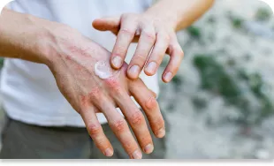 Manos aplicando crema en piel afectada por psoriasis