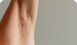 Foto clínica de una axila afectada por hidradenitis suppurativa