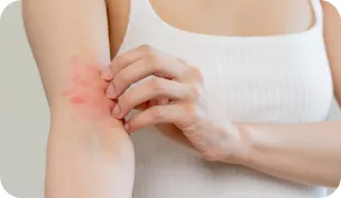 Mujer con brote en el brazo izquierdo rascándose.