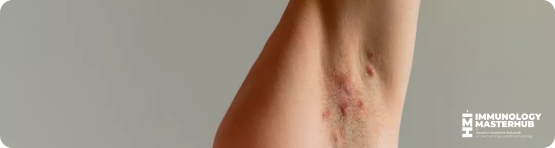 Axila afectada por hidradenitis supurativa