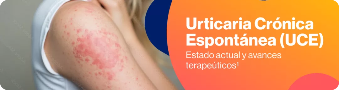 Urticaria Crónica Espontánea (UCE)