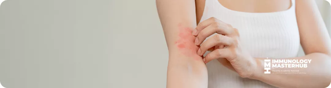 banner para la página de hidradenitis supurativa mostrando una persona con lesiones en la piel de su brazo